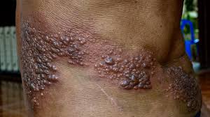 shingles vs herpes how to tell the