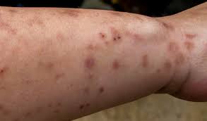 If you have this allergy you may have severe rashes, pain, irritation and itching. Bed Bugs Get Your Bedbug Treatments Today From Waspkill Uk