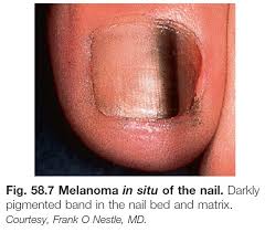 nail disorders chapter 58