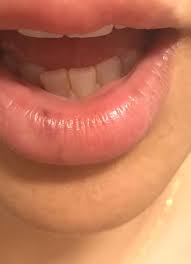 dark spots in my lips after filler 1