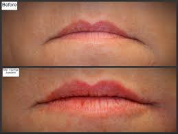 perfect your pout w juvederm millefiori
