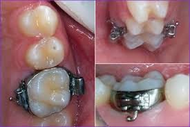 chainette elastique orthodontique fermer les espaces que