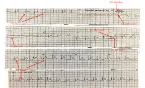 Oct 21, 2020 · pericarditis causes a specific sound, called a pericardial rub. Acute Pericarditis 101 Self Treatment Leads To Mistreatment American College Of Cardiology