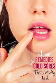 cold sore home remes that actually