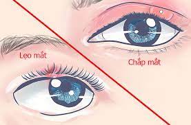 3 bệnh mắt mùa hè: Chắp và lẹo mắt