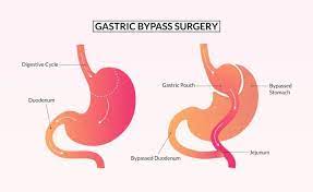 gastric byp risks obesity surgery