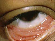 This opens in a new window. Conjunctivitis Wikipedia