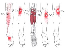 Gastrocnemius The Trigger Point Referred Pain Guide
