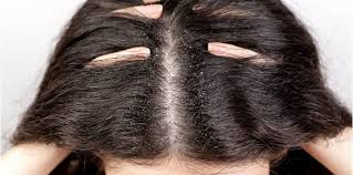 Sudah menjadi rahasia umum bahwasanya menggunakan minyak rambut yang tepat secara rutin dapat menjadi langkah ampuh. Merawat Kelemumur Guna 10 Cara Paling Berkesan Ini