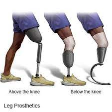 lower limb prosthesis what you need