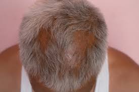advanced alopecia treatment mumbai