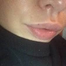 freckle mole removed on my lip photo