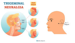 trigeminal neuralgia causes triggers
