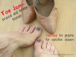 bruised and broken toenails