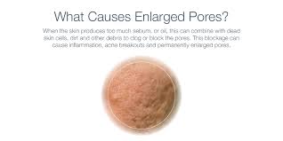 enlarged pores