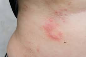 treatment options to get rid of hives fast