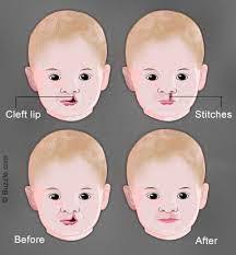 cleft lip cosmetic surgery at best