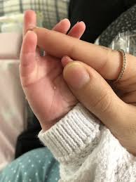 spots on baby s hand what is it