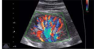 colour doppler ultrasound
