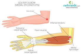 golfer s elbow causes symptoms and