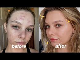 natural makeup routine with acne