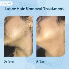 laser hair reduction