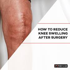 reduce knee swelling after surgery