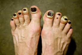 toenail blisters 7 causes 7 fi