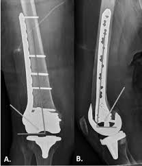 periprosthetic distal femur fractures
