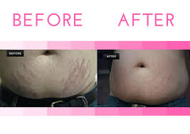 stretch mark reduction services at