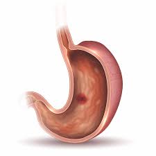 peptic ulcer disease causes