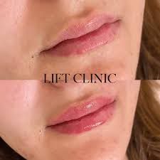 lip fillers toronto lip injections