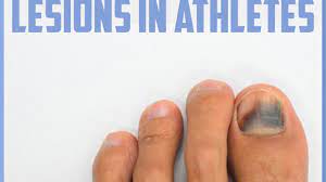 common toenail injuries in athletes