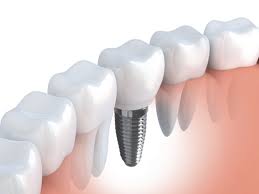 dental implants medford and grants p