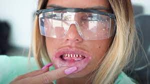As katie price reveals she's had reconstructive surgery to correct a botched facelift, shocking pictures show just how much the star. Katie Price Spits Out New Teeth After Getting James Bond Villain Fangs Fixed Aktuelle Boulevard Nachrichten Und Fotogalerien Zu Stars Sternchen