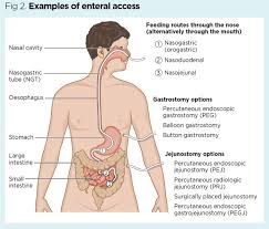 Selection And Management Of Commonly Used Enteral Feeding