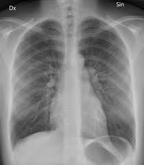 It is used to evaluate the lungs, heart and chest wall and may be used to help diagnose shortness of breath, persistent cough, fever, chest pain or injury. Chest Radiograph Wikipedia