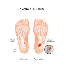 top 5 exercises for plantar fasciitis