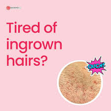 how to treat ingrown hair