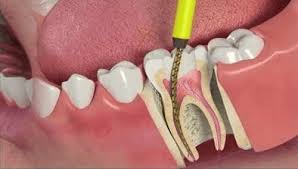 Root Canal Treatment |