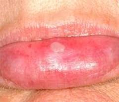 7 causes of white dots on lips with