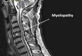 myelopathy causes symptoms