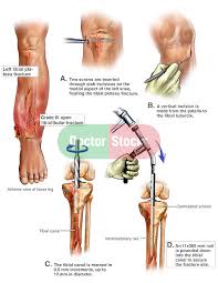 left tibial and fibular fractures with