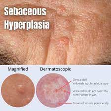 best sebaceous hyperplasia treatments