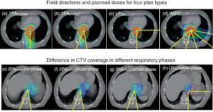 esophageal cancer