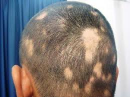 When trying to decide which hairstyle would go best with your receding hairline a barber or hair stylist will look at how your face, the shape of your head, whether it's oblong, round etc. Is Microneedling Effective For Alopecia Or Hair Loss What Are The Updates On Hair Loss Treatment Derma Roller Shop
