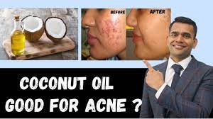 is coconut oil good for acne clear