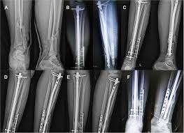 tibial fractures
