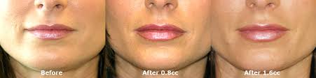 juvederm lip enhancement 215 dr