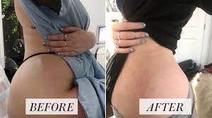 prp injections for stretch marks
